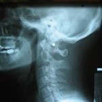 spine_xray Radiograph of spine